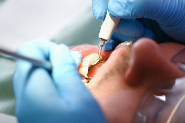 Best Emergency Root Canal Treatment in Grandville, MI